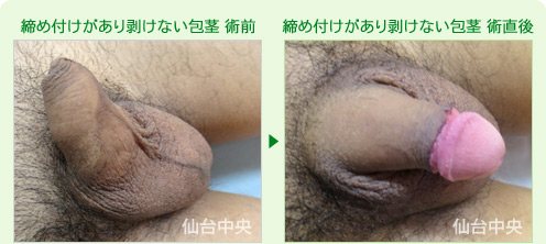 締め付けがあり剥けない包茎1 症例写真1